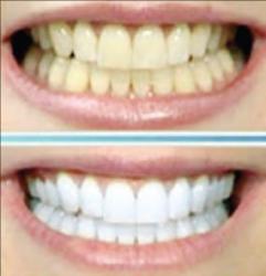 وصفة الدكتور جمال الصقلي للتخلص من إصفرارالأسنان