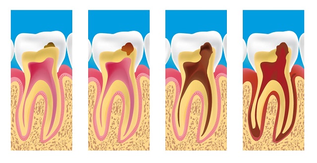 علاج تسوس الاسنان والوقاية منه