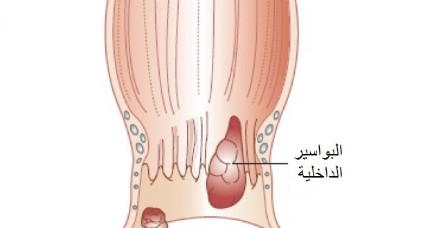 علاج البواسير الداخلية نهائياً وبدون رجعة